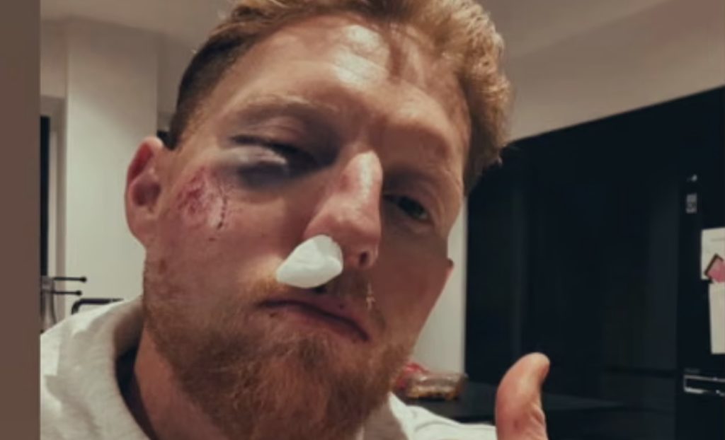 Ben Stokes facial injury