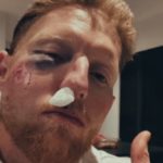 Ben Stokes facial injury